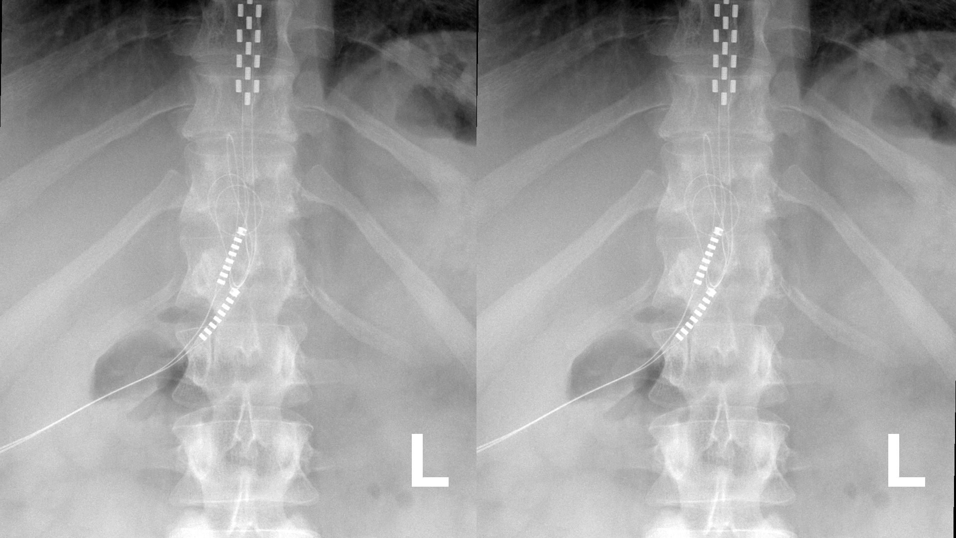 TGA Reveals Concerning Post Market Review Of Spinal Cord Stimulators 